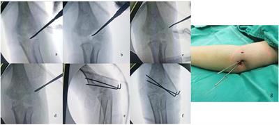 A Comparative Study on Closed Reduction vs. Open Reduction Techniques in the Surgical Treatment of Rotated Lateral Condyle Fractures of the Distal Humerus in Children